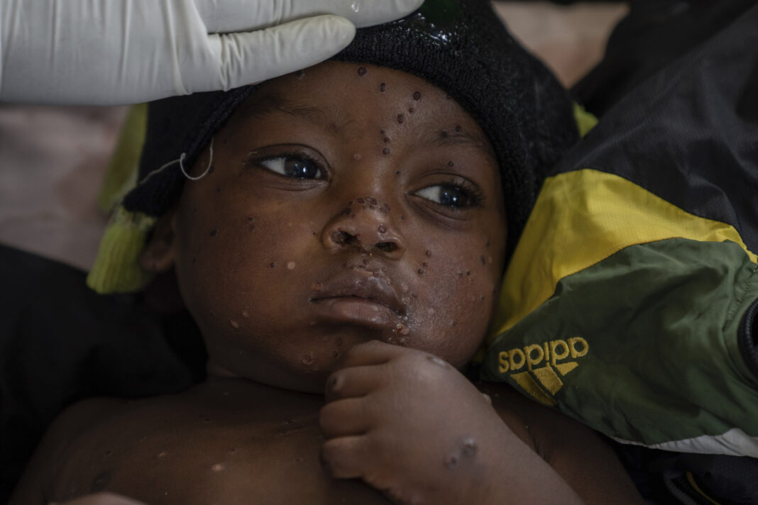 aptopix-congo-mpox-outbreak-epicenter-20584.jpg