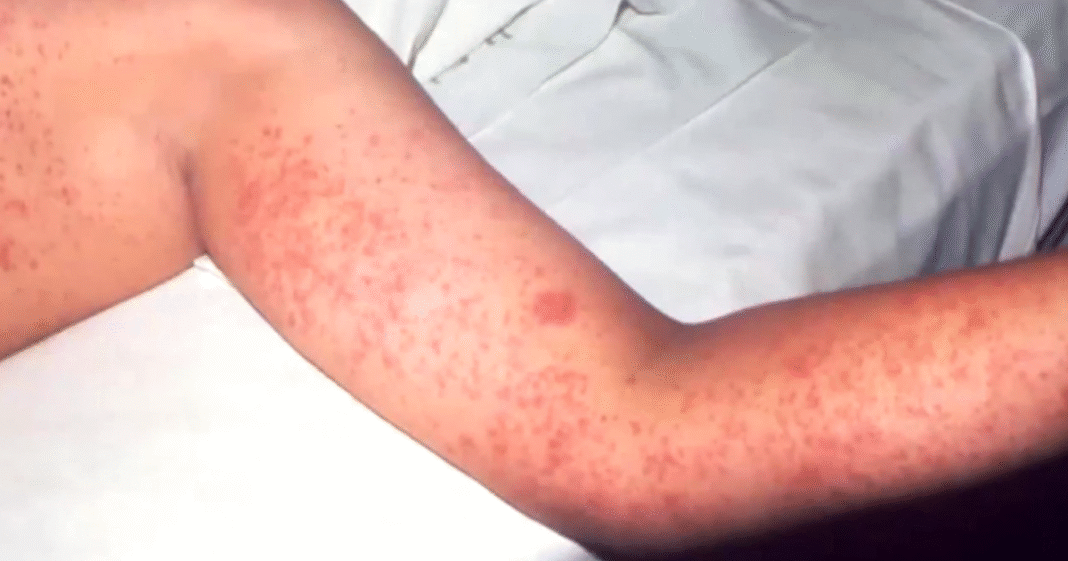 Weekly measles cases hit new record amid worst outbreak since 1990s