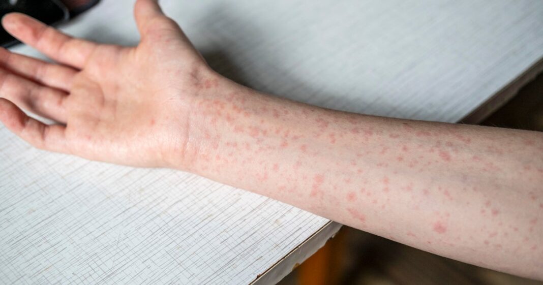 CDC urges summer camps to check for measles immunity, as U.S. nears record
