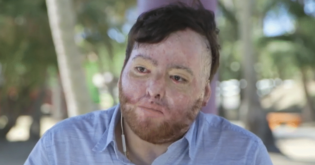 U.S. citizen billed $1.7 million by government for life-saving burn treatment: “Completely hopeless”