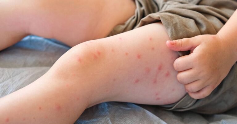 Warning to anyone going on holiday this month over deadly mosquito bites | UK | News