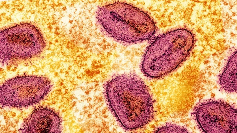 First Locally Acquired US Case of Severe Mpox Strain Identified in California