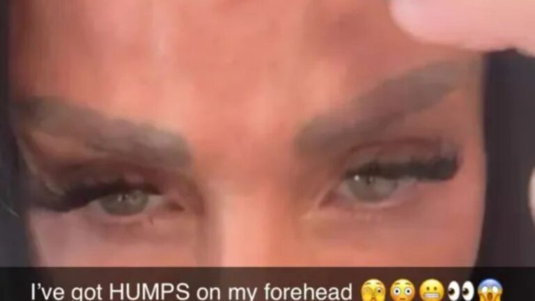 Katie Price shares worrying snap of ‘humps’ on forehead after Botox as she struggles with health woes and weight loss