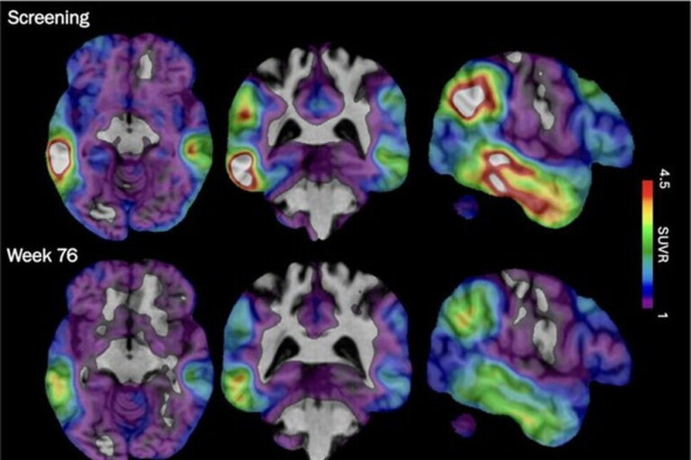 An Experimental Alzheimer’s Drug Shows Promise Targeting a Different Brain Protein, New Study Shows