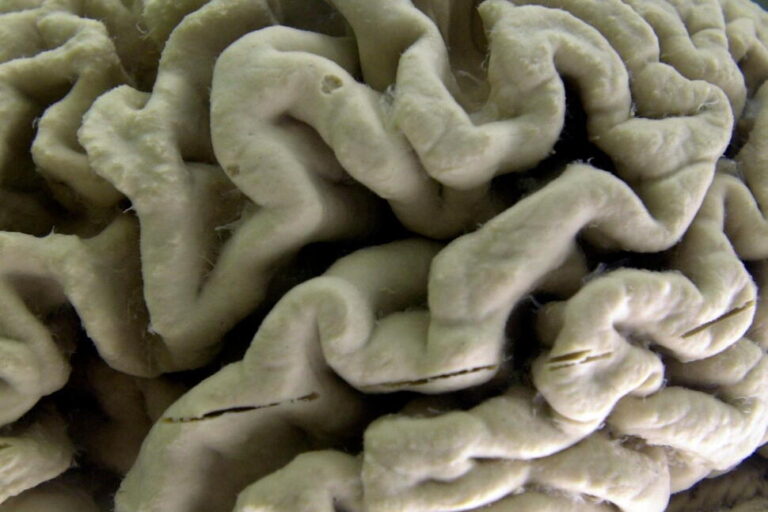 Study Shows a Blood Test Can Help Identify Healthy People at High Risk for Alzheimer’s Disease