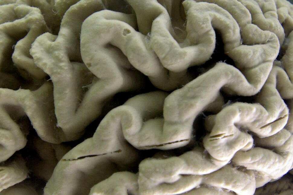 Study Shows a Blood Test Can Help Identify Healthy People at High Risk for Alzheimer’s Disease
